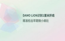 达摩院DAMO LiON模型精准识别微小肝癌病灶